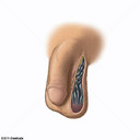 Varicocele