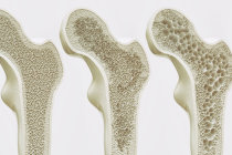 6 maneiras de proteger seus ossos contra a osteoporose e evitar fraturas