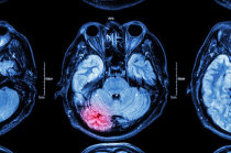 Acidente vascular cerebral em jovens