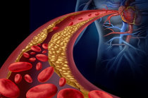 Ateromas - conceito, causas, características, diagnóstico, tratamento, prevenção