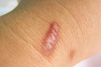 Cicatriz hipertrófica - quais as diferenças com os queloides?