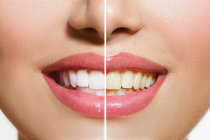 Clareamento dental - tem jeito dos dentes ficarem mais brancos