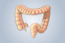 Colostomia: porque é feita, como é realizada, quais os cuidados que devem existir para evitar complicações