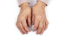 Como é a osteoartrite?