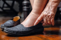 Edema dos membros inferiores