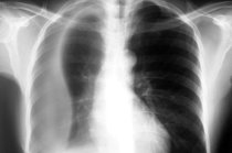 Empiema pleural ou pus na cavidade pleural: o que é isso? Tem jeito de evitar?
