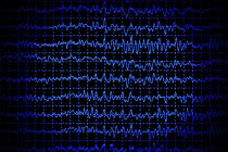 Epilepsia rolândica: conheça uma das formas mais comuns de epilepsia infantil Epilepsia rolândica: conheça uma das formas mais comuns de epilepsia infantil