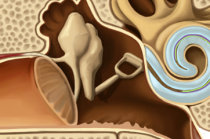 Estapedectomia: o que é? O que ela trata? Quando fazer?