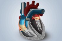 Estenose mitral: o que é? Quais as causas? E os sintomas? Como são o diagnóstico e o tratamento? Como é a evolução? Existe prevenção?