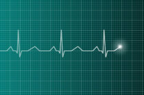 Fibrilação ventricular: conceito, causas, sintomas, diagnóstico, tratamento, prevenção e evolução