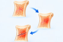 Fratura por estresse: quando a dor do exercício pode ser sinal de uma lesão no osso Fratura por estresse: quando a dor do exercício pode ser sinal de uma lesão no osso