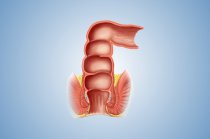 Hemorroida ou doença hemorroidária. O que saber sobre ela?
