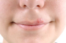 Herpes Simples. O que é?