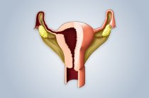Histerectomia ou retirada do útero: o que é? Quem deve fazer? Quais são os riscos? Como evolui?