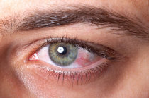 Olho vermelho - o que fazer? Quais podem ser as causas?