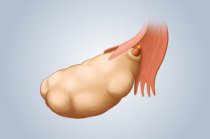 Ooforite ou ovarite: causas, sintomas, diagnóstico e tratamento