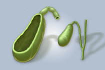 P&oacute;lipos da ves&iacute;cula biliar