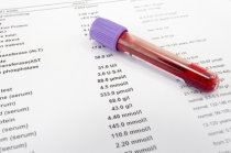 Síndrome antifosfolípide - sintomas, diagnóstico, tratamento e evolução Síndrome antifosfolípide - sintomas, diagnóstico, tratamento e evolução