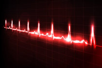 Taquicardia sinusal Taquicardia sinusal