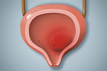 Ureterocele: causas, sintomas, diagnóstico, tratamento e possíveis complicações