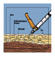 Fuzeon® (enfuvirtida)