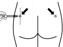 Sandostatin LAR